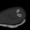 SPORK, NICO - 22.03.1976 - 02.08.2022 - CT obere Extremität - 18:02:23